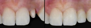 porcelain crowns