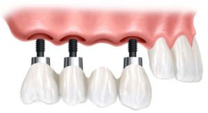 dental implants