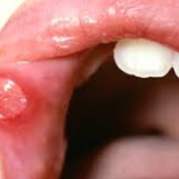 Ulceration Ulceration